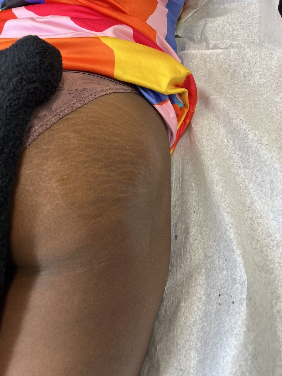 KlassikMinxxx's tweet image. Before and after of Vacuum therapy 

#cellulitereduction #vacuumtherapy #nonsurgical #cellulite #lipocavitation #radiofrequency #fatfreezing #liposuction #bodybuilding #botox #cellulitetreatment #atlanta #bhfyp #fayettevillegeorgia #newnangabodysculpting