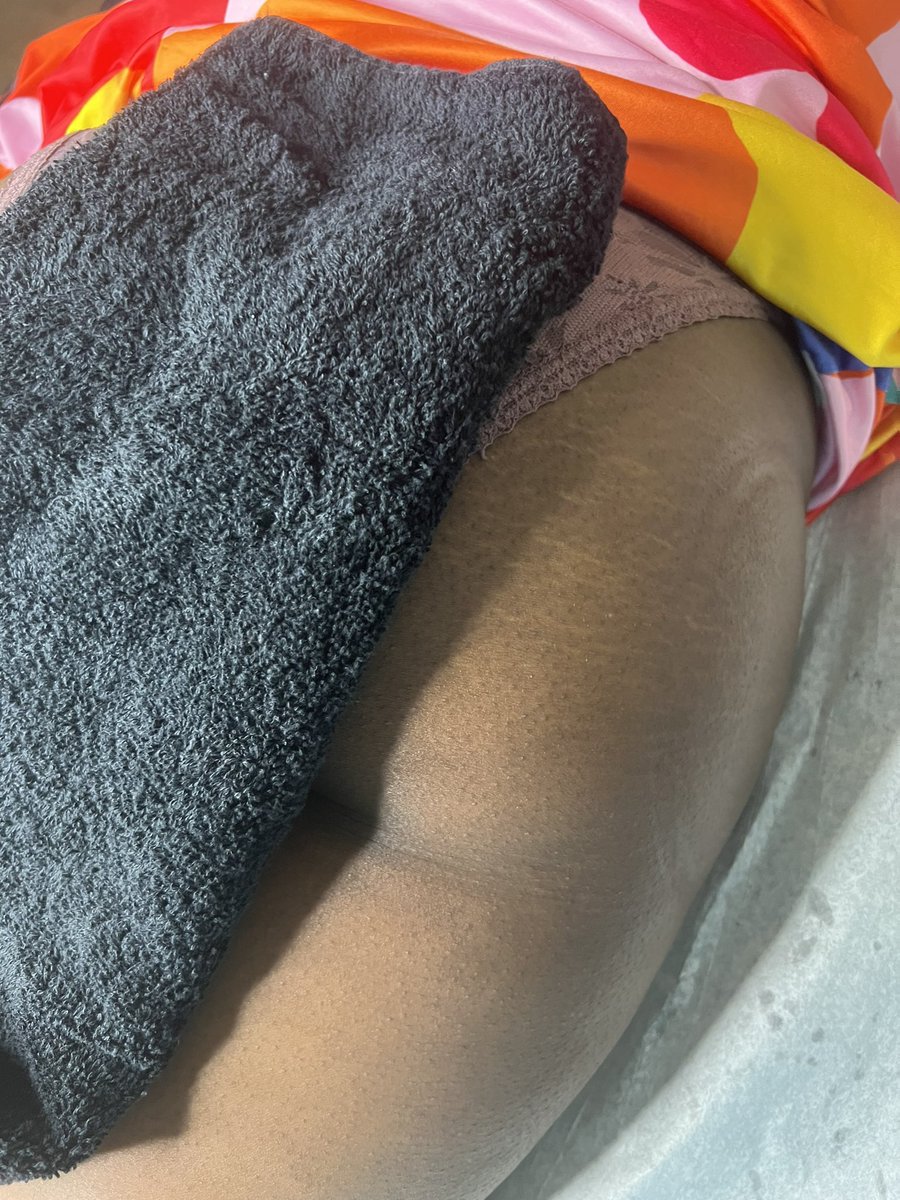 KlassikMinxxx's tweet image. Before and after of Vacuum therapy 

#cellulitereduction #vacuumtherapy #nonsurgical #cellulite #lipocavitation #radiofrequency #fatfreezing #liposuction #bodybuilding #botox #cellulitetreatment #atlanta #bhfyp #fayettevillegeorgia #newnangabodysculpting