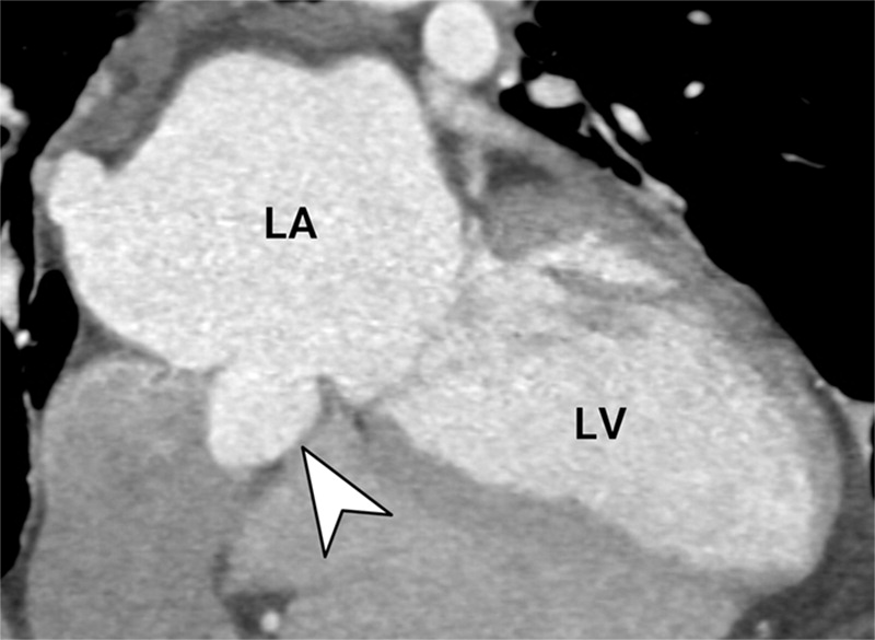 RadioGraphics (@radiographics) on Twitter photo A systematic approach to cardiac pouchings and outpouchings can help radiologists maximize diagnostic accuracy and guide patient management or further workup. bit.ly/42HCBY3 <a href="/RadiologyUcla/">UCLA Radiology</a> <a href="/RadiologyUSC/">Radiology of USC</a> A systematic approach to cardiac pouchings and outpouchings can help radiologists maximize diagnostic accuracy and guide patient management or further workup. bit.ly/42HCBY3 <a href="/RadiologyUcla/">UCLA Radiology</a> <a href="/RadiologyUSC/">Radiology of USC</a>