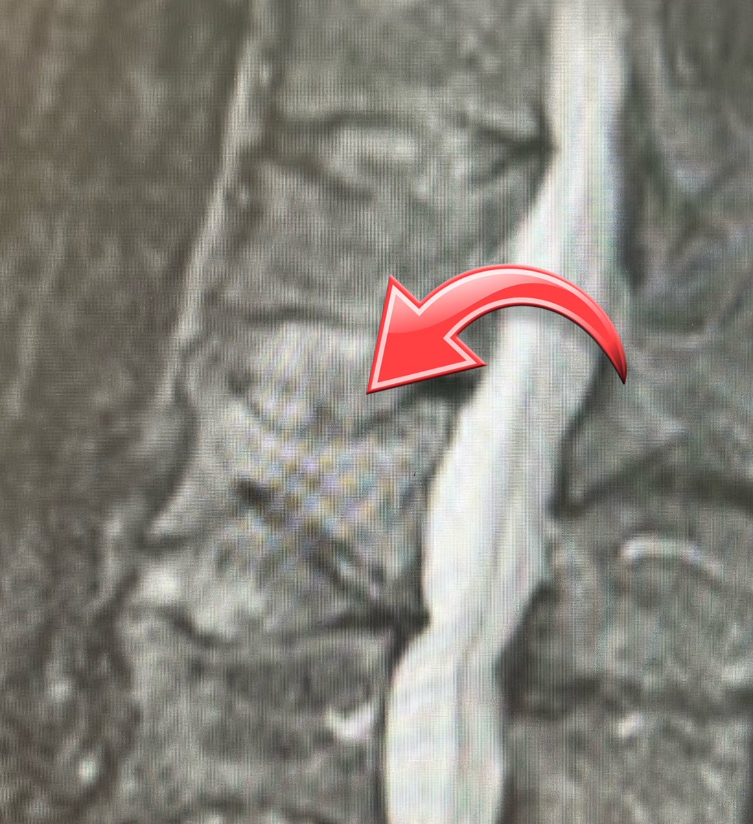 osteoporosisNI's tweet photo. This patient had a new vertebral fracture brushing the yard.
But because the DEXA showed ‘osteopenia’ they were prescribed only calcium/vitamin D.
This patient has a HIGH risk of further fracture and needs urgent referral to the FLS. @RoyalOsteoPro #osteoporosis #NOGG https://t.co/pnnvIckETL