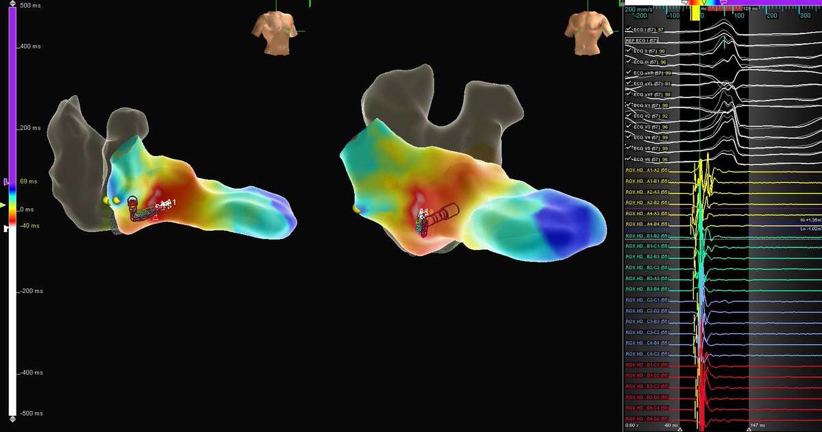 Megha Pandya (@meghapandyaep) on Twitter photo Awesome first case with <a href="/YRodriguezMD/">Yasser Rodriguez, MD, MBA</a> at <a href="/CleveClinicFL/">Cleveland Clinic Florida</a> today! Tough deep septal spot but #HDGrid gave us beautiful signals and a 🎯 to hit. No more PVCs. <a href="/martinezcarl3D/">Carlos Martinez</a> #epeeps Awesome first case with <a href="/YRodriguezMD/">Yasser Rodriguez, MD, MBA</a> at <a href="/CleveClinicFL/">Cleveland Clinic Florida</a> today! Tough deep septal spot but #HDGrid gave us beautiful signals and a 🎯 to hit. No more PVCs. <a href="/martinezcarl3D/">Carlos Martinez</a> #epeeps