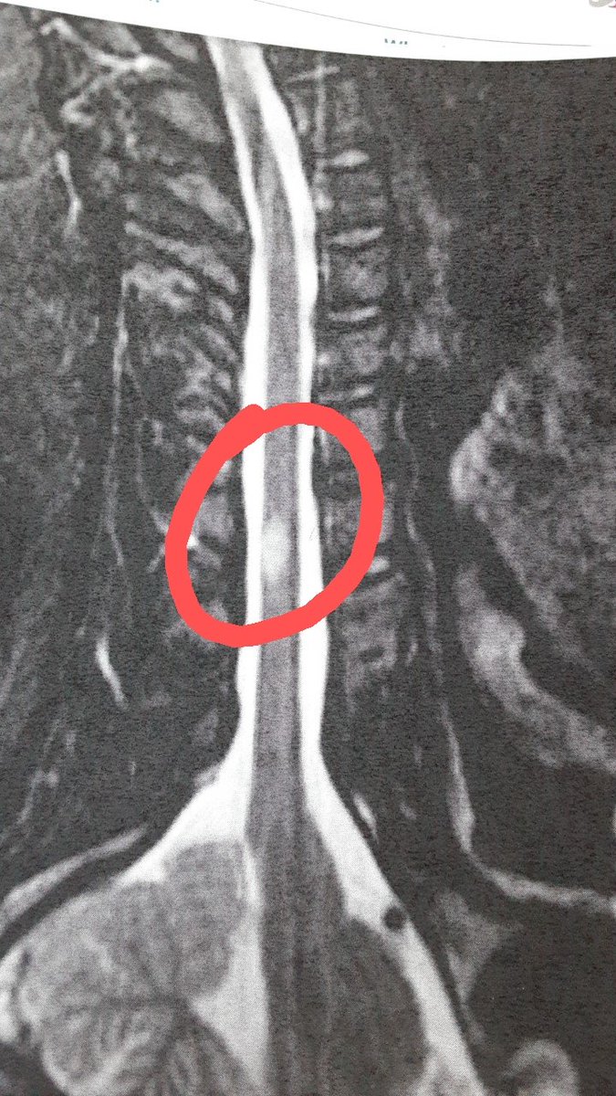 SpoonieJen's tweet photo. I have to come up with $80 for the medication and just am stumped. 

If anyone wants to donate towards the cost, my venmo is SpoonieJen, cashapp $SpoonieJen and https://t.co/CtAV9S0m57

Attached is a pic from my MRI, the circled white spot is scar tissue from the MS. Fml. 😭 https://t.co/jYDhaa3yr8