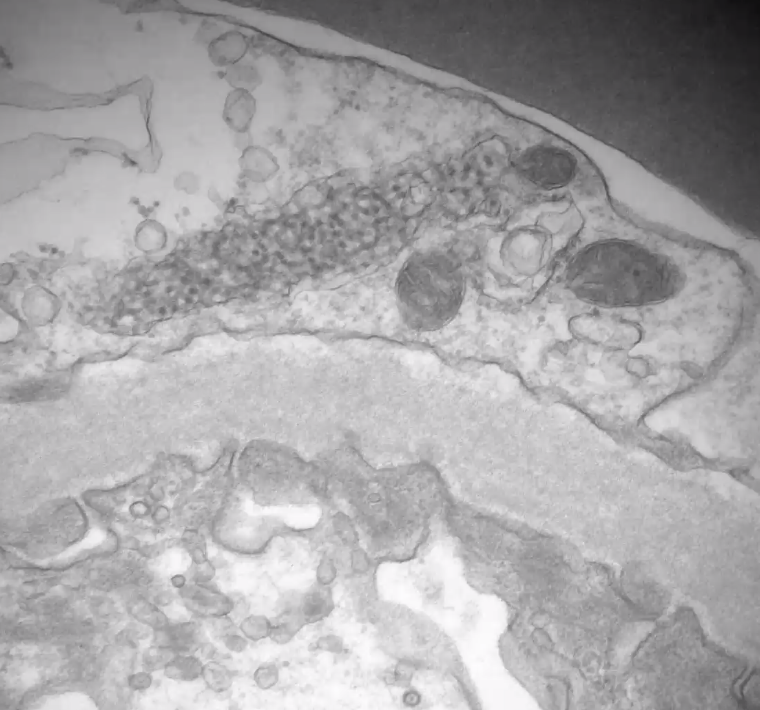 ssfarouk's tweet image. Tubuloreticular inclusion (TRI) in a #KidneyTransplant #KidneyPath