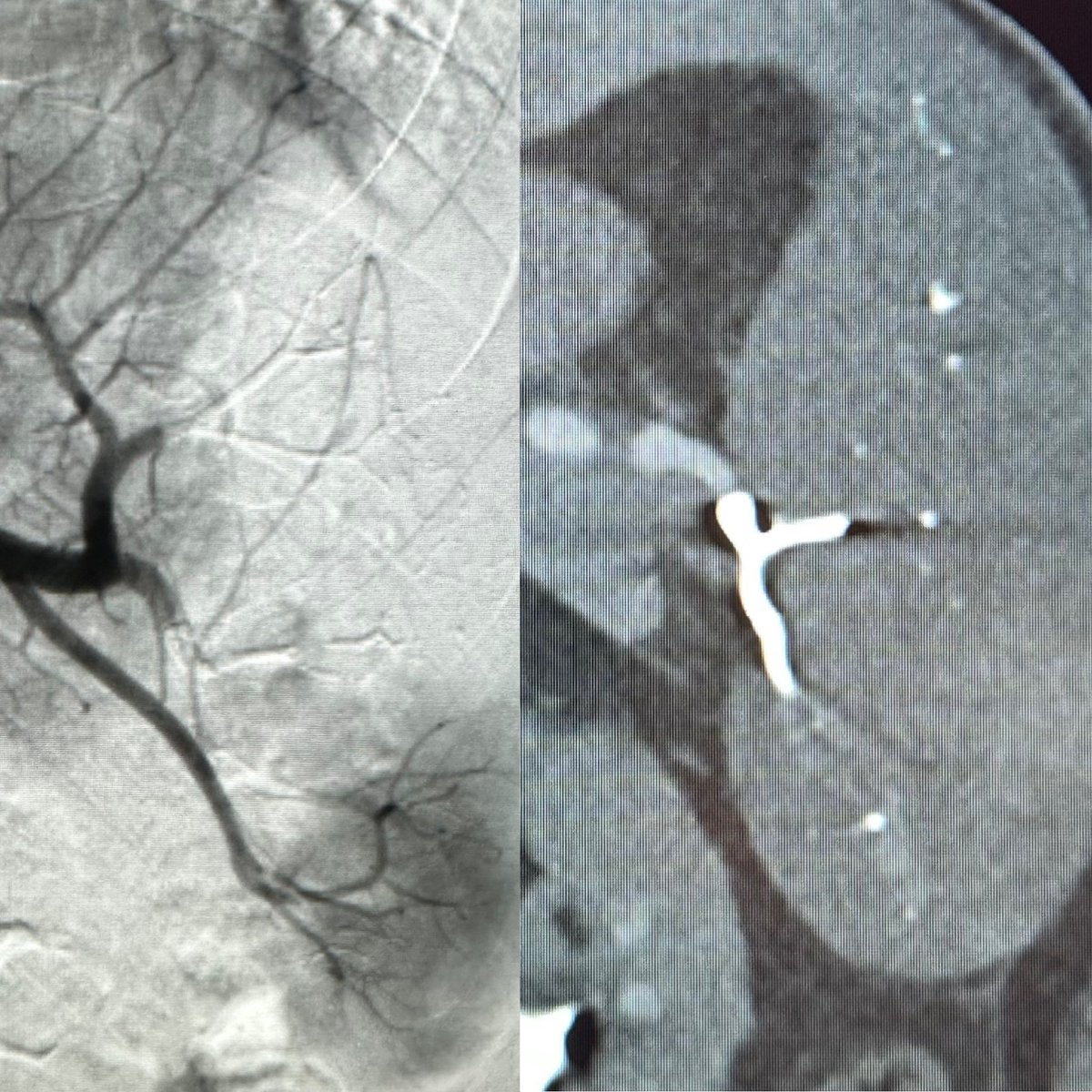 Rahmi Oklu MD, PhD (@rahmioklu) on Twitter photo Precision embolization using Obsidio gel!! Our first case!! Instant hemostasis! Made the case 5 times faster, great visibility on fluoroscopy and CT! <a href="/MayoClinicAZ_IR/">Mayo Clinic Arizona IR</a> <a href="/MayoClinic/">Mayo Clinic</a> #obsidioembolic Precision embolization using Obsidio gel!! Our first case!! Instant hemostasis! Made the case 5 times faster, great visibility on fluoroscopy and CT! <a href="/MayoClinicAZ_IR/">Mayo Clinic Arizona IR</a> <a href="/MayoClinic/">Mayo Clinic</a> #obsidioembolic