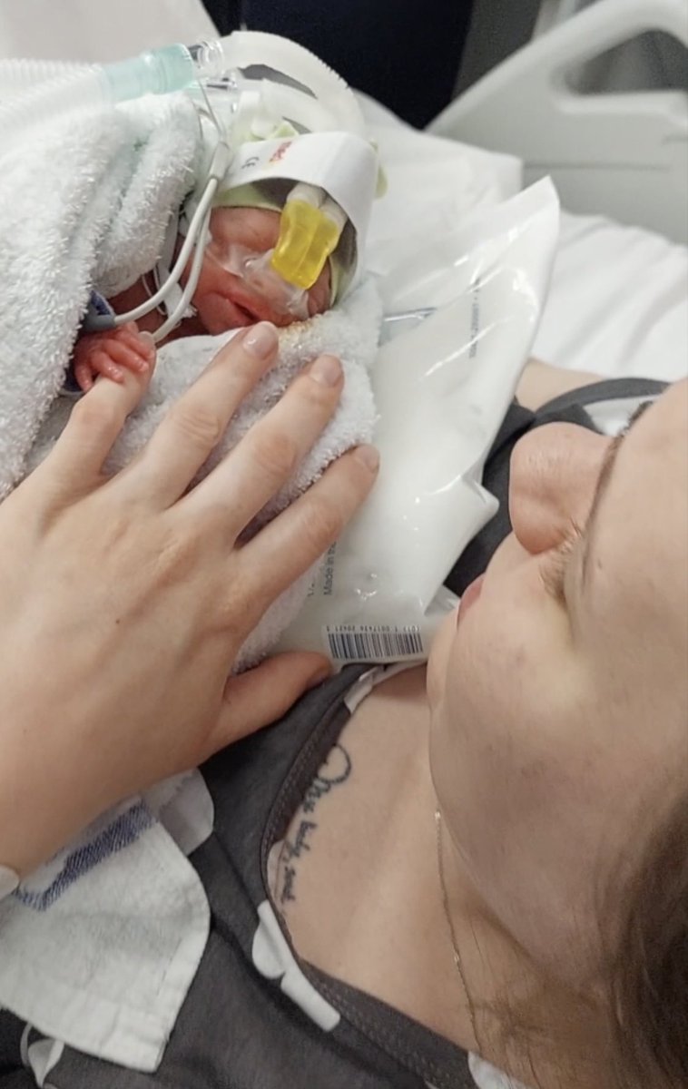 drpaulclarke's tweet photo. Now @YouTube forevermore.
Hear direct from *five* truly amazing mothers exactly why #DeliveryRoomCuddle
#BirthDayCuddle
is so vitally important for them & their preterm babies! 🥲
👉https://t.co/u3WmmFEXFL
Thank you so much
❤️@FabianaBacchini
🇨🇦@canadianpreemie
@Blisscharity https://t.co/rGVVrfANQo