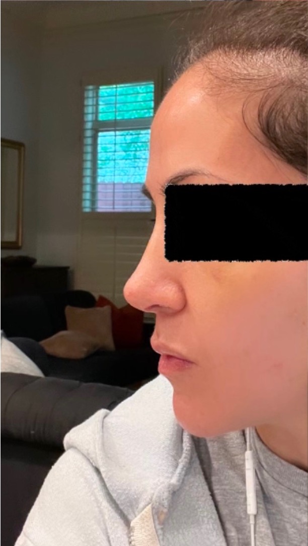 Finesse #rhinoplasty for this amazing patient, who developed a bridge bump after nasal trauma. She's only 10 days out from her #nosesurgery and is loving her new, subtly refined nose!

Learn more here: avivaplasticsurgery.com/nose/rhinoplas…

#rhinoplastyexpert #beforeandafter #nosejob