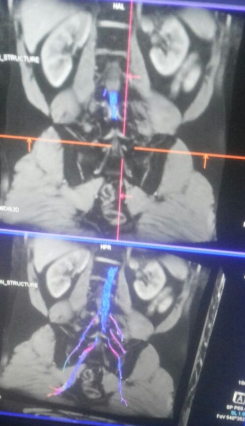 Badr19913's tweet photo. @thomas_jesson This one of my thesis photos
Really the diffusion helps me alot in understanding how physio may help patients to get recovered for radiculopathy https://t.co/9pnqs5WS33