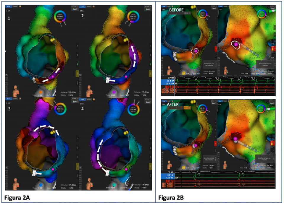 💡ICOT Clinical case of the week💡
🫀La verità è spesso ciò che non appare: un caso di tachicardia atriale focale che mima una recidiva di flutter atriale tipico comune🫀
📌Leggi il caso clinico:
italiancot.it/.../la-verita-…
#cardiology #cardiologyfellow #ECG #cardiac #ITcardiology