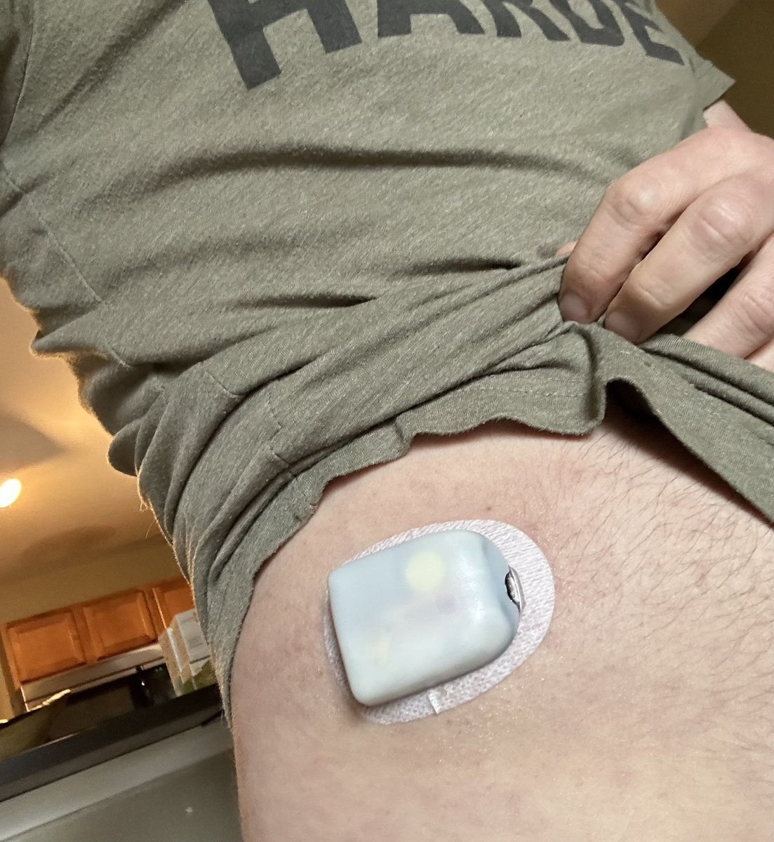 fleetingyeets's tweet image. After 20+ years of being connected to an insulin pump via a tube, I’ve made the leap to wearable pods. Thankful to still be using the #Loop app to control the pump, which is what matters most.

Any tips or tricks for a new podder?

#T1D #diabetes #WeAreNotWaiting