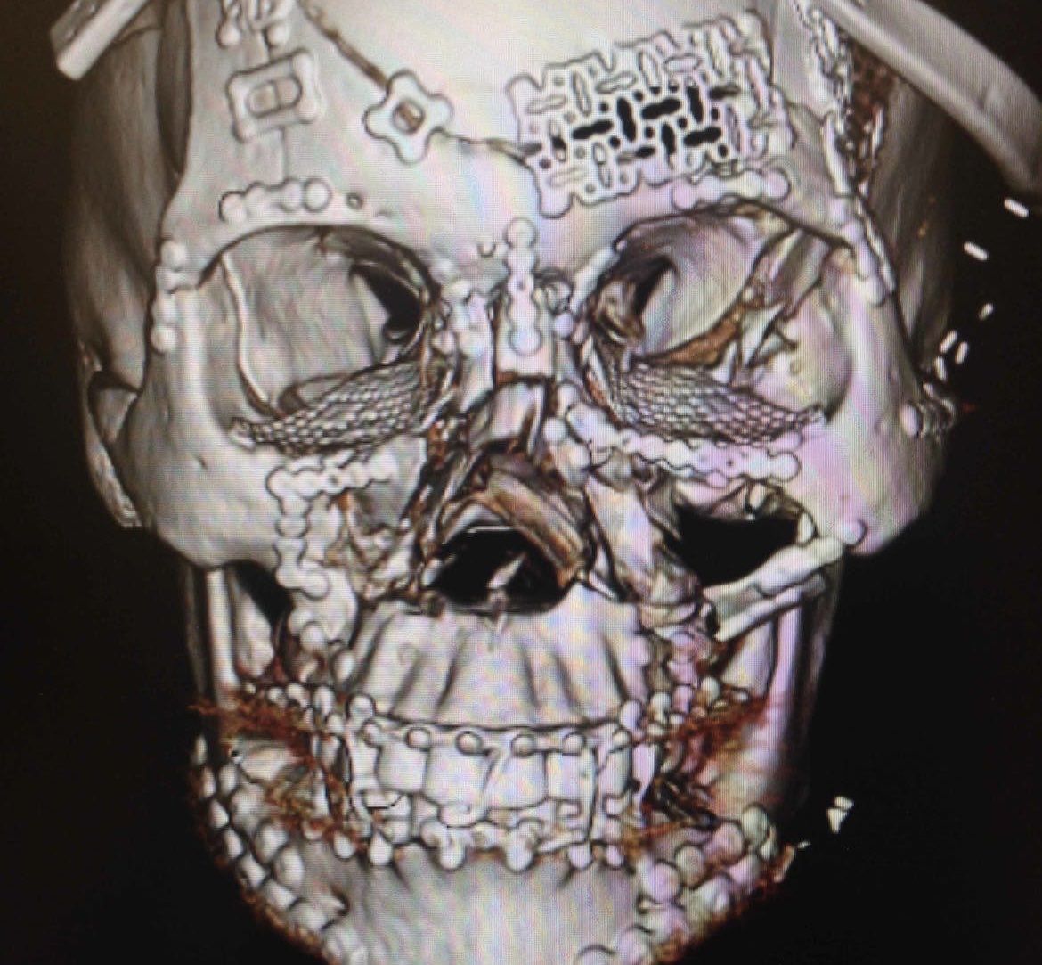 Remarkable repair of facial fractures is an understatement by sidsid #trauma #fracture #headtrauma #brain #neurosurgery #plastics