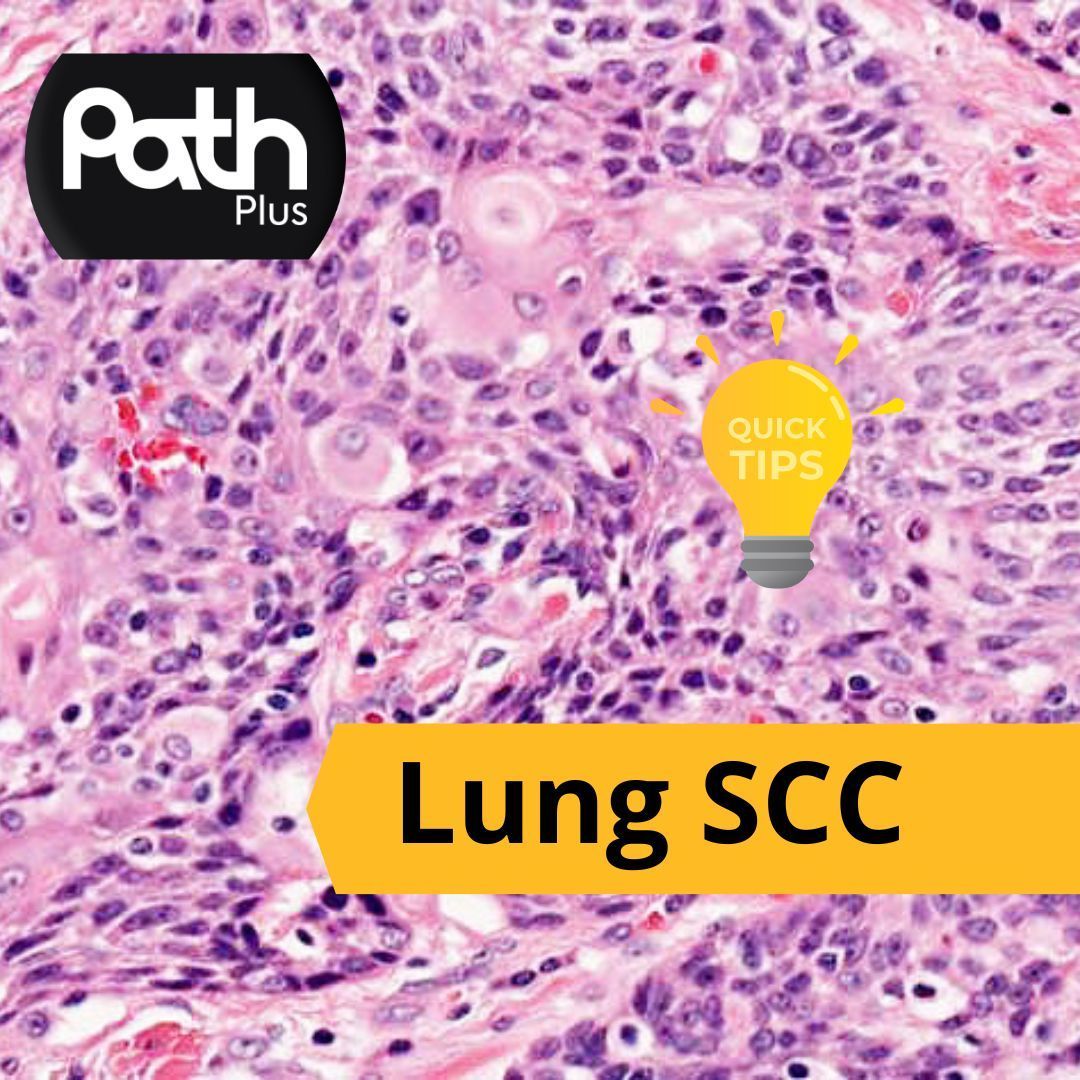 GeronimoJrLapac's tweet photo. 👌Did you like the Post?
🎯Check out many tips on lung tumors

🔥https://t.co/QeRbmS9ygW https://t.co/Y4M60PfQSK