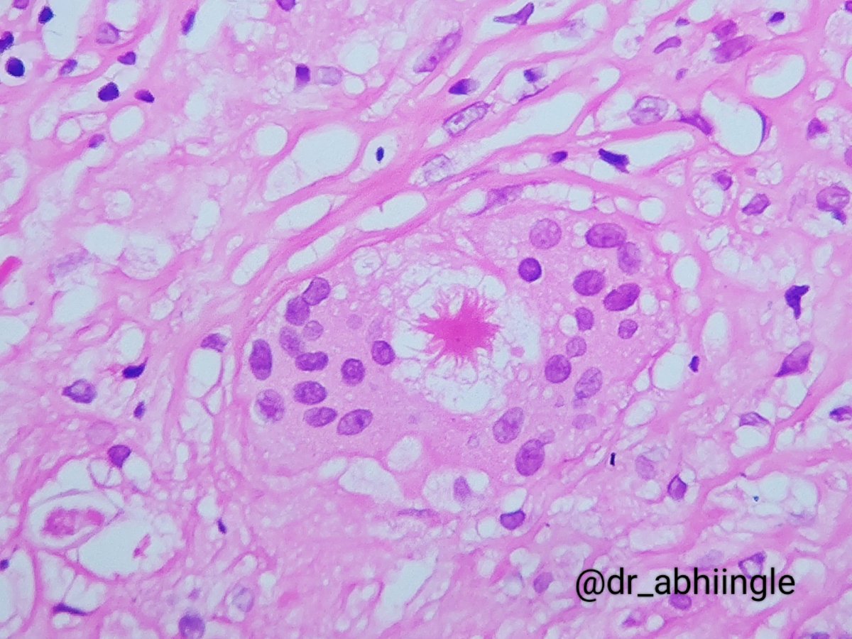 dr_abhiingle's tweet photo. #PathTwitter
#pathology
May Day! May Day!!
A 'Giant Asteroid' has landed in bx from iliac fossa along with invasion by fungal hyphae 😀 (May 1st)
#asteroidbody https://t.co/O3Psod611p