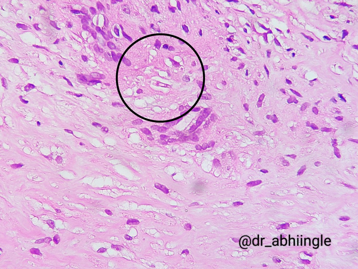 dr_abhiingle's tweet photo. #PathTwitter
#pathology
May Day! May Day!!
A 'Giant Asteroid' has landed in bx from iliac fossa along with invasion by fungal hyphae 😀 (May 1st)
#asteroidbody https://t.co/O3Psod611p