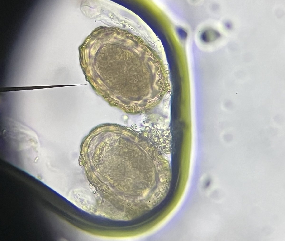 ผู้ป่วยเด็กอายุ 8 ปีมาด้วยปวดท้อง และวินิจฉัยว่าสงสัยลำใส้อุดตันเฉียบพลัน 
ขณะเข้าผ่าตัดพบว่ามีหนอนพยาธิตัวกลมคลายออกมาทางปาก และผ่าตัดไปพบหนอนพยาธิอุดตันลำไส้เล็ก

ตรวจอุจจาระ พบไข่พยาธิดังแสดง