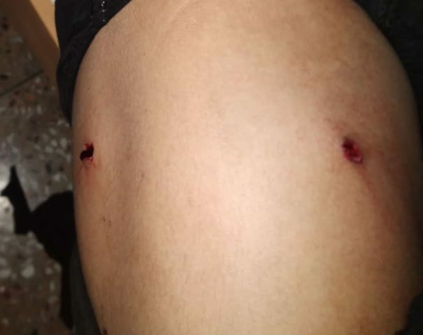 HauPaite's tweet photo. I call on the SP @Ccpur_Police to explain how and what assumption of #livebullet may have caused such injury? The victim was admitted at the District Hospital #Lamka #ManipurOnFire #churachandpur @NELiveTV @ndtv @TOIIndiaNews @Telegraph @IndiaToday @the_hindu @htTweets https://t.co/7oVDp0bdZa