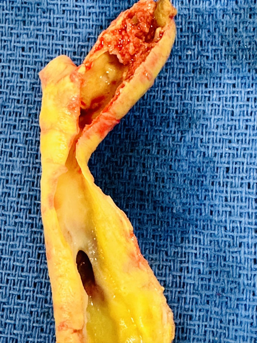 Tandem carotid lesions :  CCA ulcer with ICA ruptured plaque!! Double whammy!@FutureVascSurgn and students.