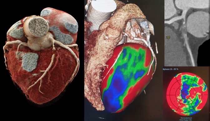 Young woman with atypical chest pain CT angiography : prox LAD occlusion Static CT Myocardial Perfusion Imaging : severe hypoperfusion of anterior wall what else ? @mirvatalasnag @DrMarthaGulati @mmamas1973 @SABOURETCardio @TernacleJ @bibi0562 @jedicath @Obisht @FCademartiri