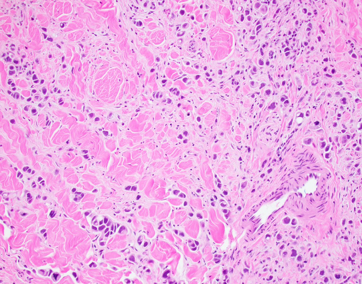 fouad_boulos's tweet photo. One in a million Monday. First of all, my apologies to all placental pathologists reading this tweet, this is not personal, your work is noble, and you are appreciated. But I can't say I'm a fan of placental pathology. The reason is the times placental pathology provides any measure of clinical utility are exceedingly rare. The mother is there, the baby is there, and looking at the placenta for signs of a disease process is like taking your car to the mechanic and watching him check the plumbing in your garage. With all that in mind, pathology is at least in part the science of looking for the unexpected. And in this particular case, this tenet of pathology was fully and mind-blowingly realized. The attached pictures are from the placenta of an unfortunate young lady with symptoms of preeclampsia at 38 weeks of gestation. No history of medical problems at the time of delivery. The last image is from a subsequent breast biopsy @wusm_pathology @washupathedu #PathTwitter #BreastPath #BreastCancer