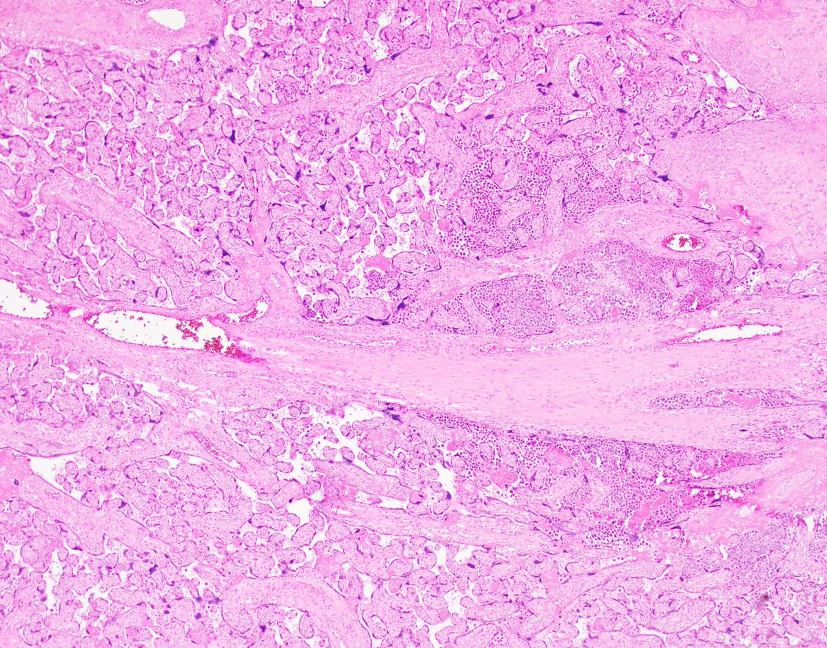 fouad_boulos's tweet photo. One in a million Monday. First of all, my apologies to all placental pathologists reading this tweet, this is not personal, your work is noble, and you are appreciated. But I can't say I'm a fan of placental pathology. The reason is the times placental pathology provides any measure of clinical utility are exceedingly rare. The mother is there, the baby is there, and looking at the placenta for signs of a disease process is like taking your car to the mechanic and watching him check the plumbing in your garage. With all that in mind, pathology is at least in part the science of looking for the unexpected. And in this particular case, this tenet of pathology was fully and mind-blowingly realized. The attached pictures are from the placenta of an unfortunate young lady with symptoms of preeclampsia at 38 weeks of gestation. No history of medical problems at the time of delivery. The last image is from a subsequent breast biopsy @wusm_pathology @washupathedu #PathTwitter #BreastPath #BreastCancer