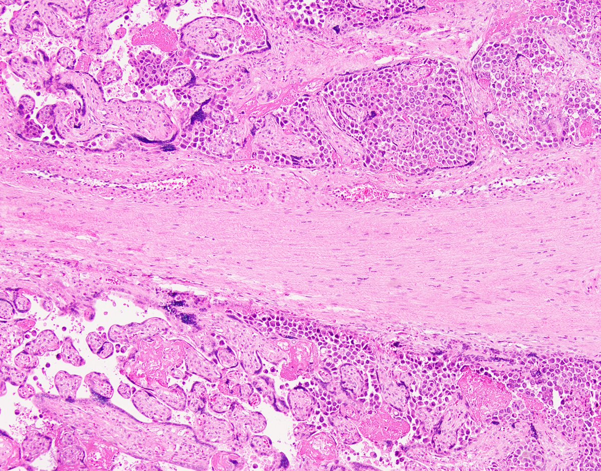 fouad_boulos's tweet photo. One in a million Monday. First of all, my apologies to all placental pathologists reading this tweet, this is not personal, your work is noble, and you are appreciated. But I can't say I'm a fan of placental pathology. The reason is the times placental pathology provides any measure of clinical utility are exceedingly rare. The mother is there, the baby is there, and looking at the placenta for signs of a disease process is like taking your car to the mechanic and watching him check the plumbing in your garage. With all that in mind, pathology is at least in part the science of looking for the unexpected. And in this particular case, this tenet of pathology was fully and mind-blowingly realized. The attached pictures are from the placenta of an unfortunate young lady with symptoms of preeclampsia at 38 weeks of gestation. No history of medical problems at the time of delivery. The last image is from a subsequent breast biopsy @wusm_pathology @washupathedu #PathTwitter #BreastPath #BreastCancer