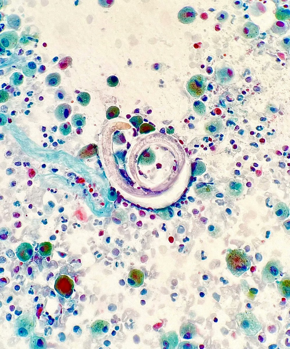 Bronchoalveolar lavage revealing larvae of what species? Answer: kikoxp.com/posts/12778 #PathTwitter #IDTwitter #MedTwitter