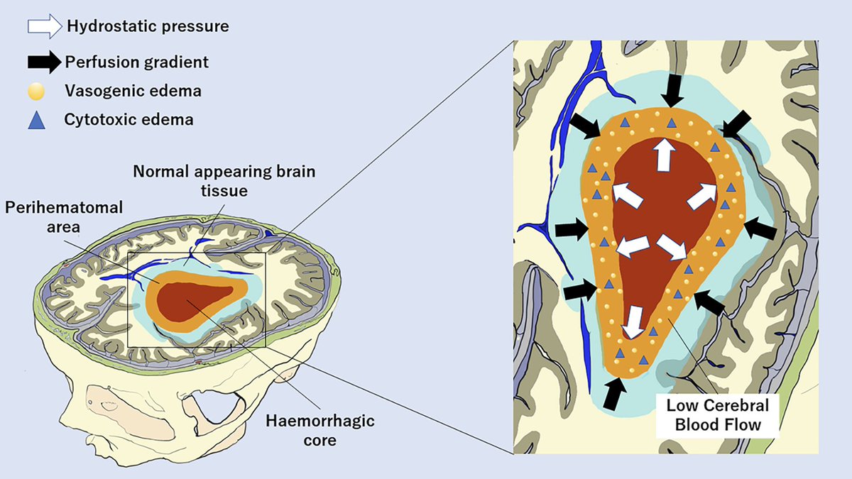 Fainardi et. al. report that perihaemorrhagic perfusion gradients promote oedema development and might represent a novel therapeutic target in the subacute phase following intracerebral haemorrhage. bit.ly/3VlqUDO
