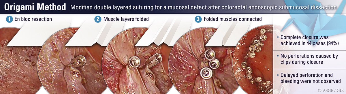 ..and this is why endoscopy is an art form! 👨🏻‍🎨

Love the Origami analogy 🎌

Do watch the video!
@bjacob_MD @JJFordeMD @KundraMD 
#asge #GITwitter #endoscopy #thirdspace