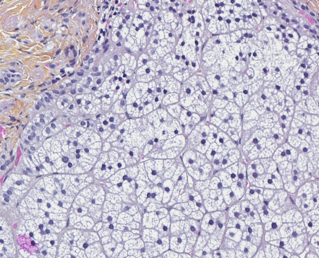 A small yellow parasalpingeal nodule incidentally detected during surgery in a young woman with suspected endometriosis :
#PathTwitter #pathresidents #gynpath #pathoutpic