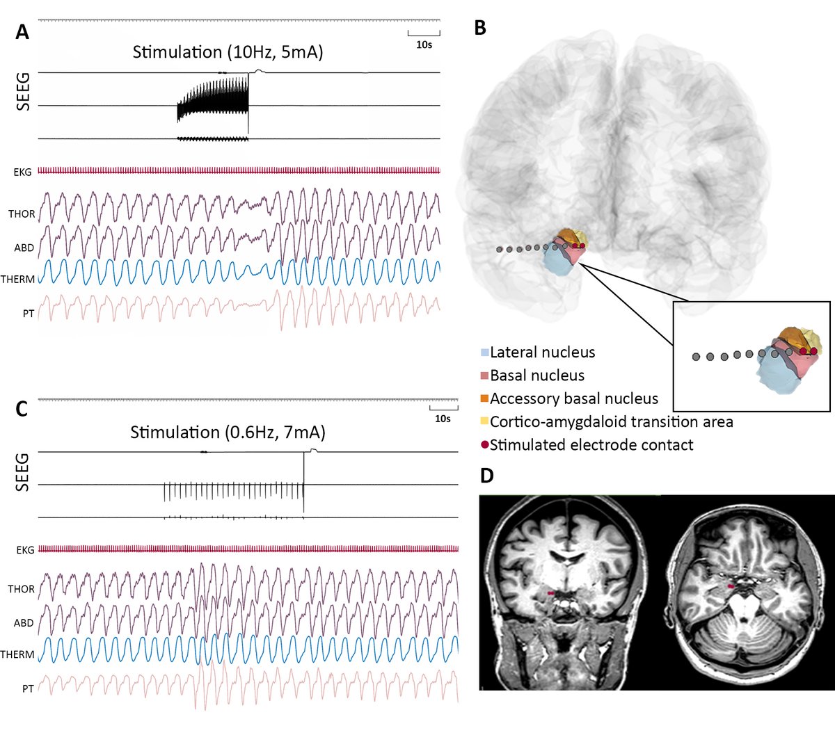 EpilepsiaJourn's tweet photo. Stimulation-induced respiratory enhancement in cortico-thalamic regions
https://t.co/FsdhTglmOJ
#Corticalstimulation #Enhancementofbreathing #Thalamicstimulation #epilepsy #epilepsyresearch #ILAE @IlaeWeb @yesILAE @epilepsiajourn @WileyNeuro https://t.co/xPnphyoNFo