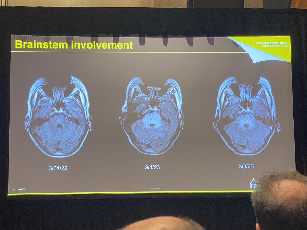 Maria Gule-Monroe MD (@mariagulemonroe) on Twitter photo PRES is not always posterior and not always reversible <a href="/bpoliceni/">Bruno Policeni</a> showing some great cases with posterior fossa and brain stem involvement during #ASNR23 as part of the SILAN program session <a href="/RoyRiascosMD/">Roy Riascos MD, MBA, FACR</a> PRES is not always posterior and not always reversible <a href="/bpoliceni/">Bruno Policeni</a> showing some great cases with posterior fossa and brain stem involvement during #ASNR23 as part of the SILAN program session <a href="/RoyRiascosMD/">Roy Riascos MD, MBA, FACR</a>