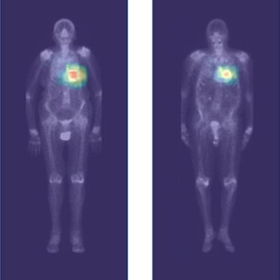 AuntMinnieEuro's tweet image. AI may help diagnose cardiac amyloidosis on whole-body scintigraphy #radiology #ImagingAI #NuclearMedicine buff.ly/42bzp6t