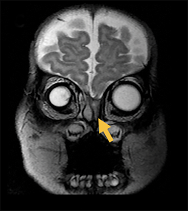 Applied_Rad's tweet photo. Pediatric Cephaloceles: This review illustrates four major types of cephaloceles using a multimodality approach with prenatal and postnatal correlation.

Full article ⏩https://t.co/ENF9ceS2CR

#medicalstudent #futureradres #radres #neurorad #pedsrad #pedscommunity https://t.co/XA2MHypQRZ