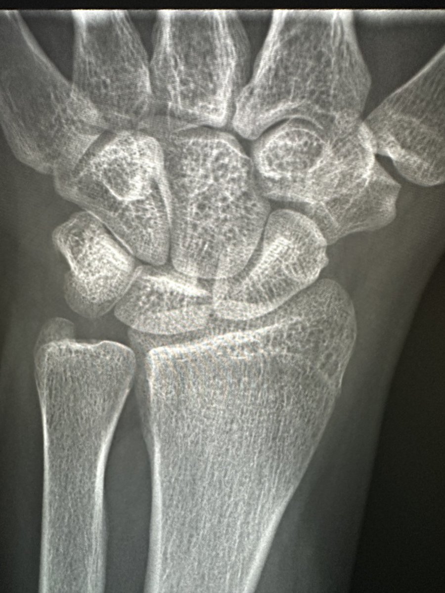 RJ on Twitter "Young male. Flexion wrist injury. Persistent pain. Several nl radiographs. Call
