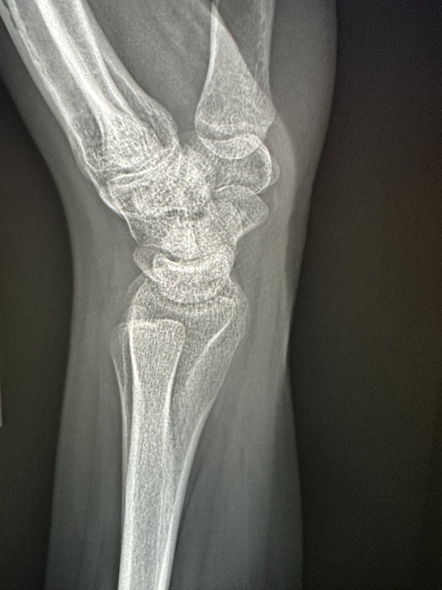 RJ on Twitter "Young male. Flexion wrist injury. Persistent pain. Several nl radiographs. Call