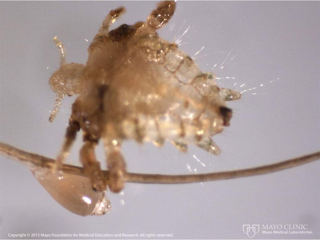 InformaCosmos's tweet photo. Piojos púbicos en extinción.

Los piojos púbicos tienen el nombre científico de Pthirus pubis. Este es un piojo, insectos chupadores de sangre sin alas que parasitan las áreas del vello púbico de los humanos. 

Los piojos púbicos adultos tienen un tamaño de 1.3 a 2 mm, no tienen alas, cuerpo blanco y poseen la misma capacidad de cambio de color que la piel humana. 

Pocas personas saben que este insecto apareció en la Tierra hace 3,3 millones de años y una vez causó estragos en Europa con solo su pequeño tamaño.

Según la revista Bloomberg, los piojos púbicos se encuentran en peligro de extinción a causa de la depilación y aseo recurrente.

La imagen nos muestra un piojo adulto, junto con un huevo característico (también conocido como "liendre") pegado al cabello. 

📸: Mayo Clinic.