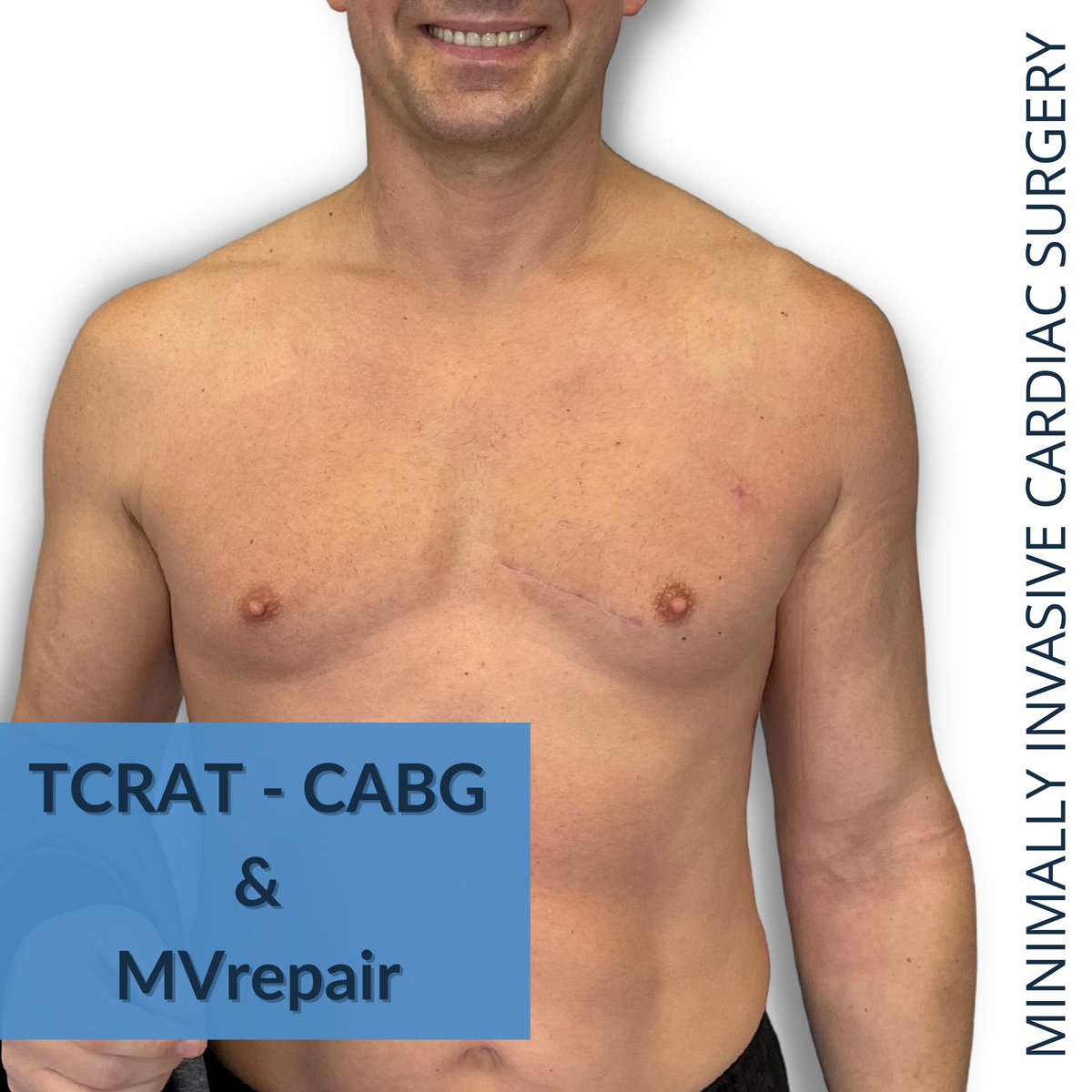 #CABG & #MitralValveRepair (ring and artificial chords). Avoiding sternotomy, only one minimally invasive approach.
1 month postop
Scar is hardly recognized on the left chest