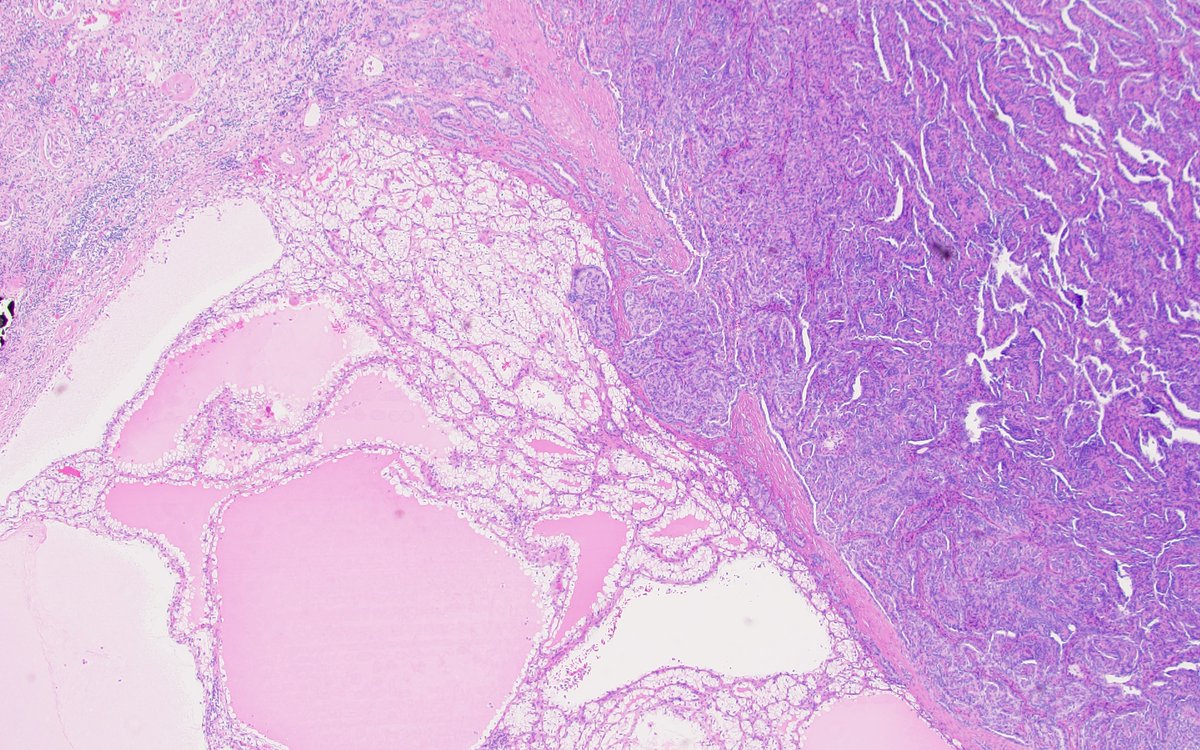 behtashg's tweet image. Collision of clear cell renal cell carcinoma and papillary renal cell carcinoma! This #prcc is trying to invade #ccrcc! #PathTwitter #gupath