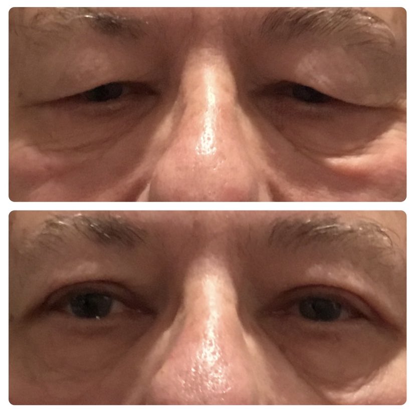 LID LIFT BY PBJ 🦋 
.
.
.
.
.
.
.
.
#oculoplastics #asoprs #ophthalmology #plasticsurgery #optometry #blepharoplasty #lidlift #cosmeticsurgery #eyelidsurgery #bleph #beforeandafter #beautiful #face #facialplastics #gay #gaydoctor #injector #surgeon #cherryhill #cherryhillnj