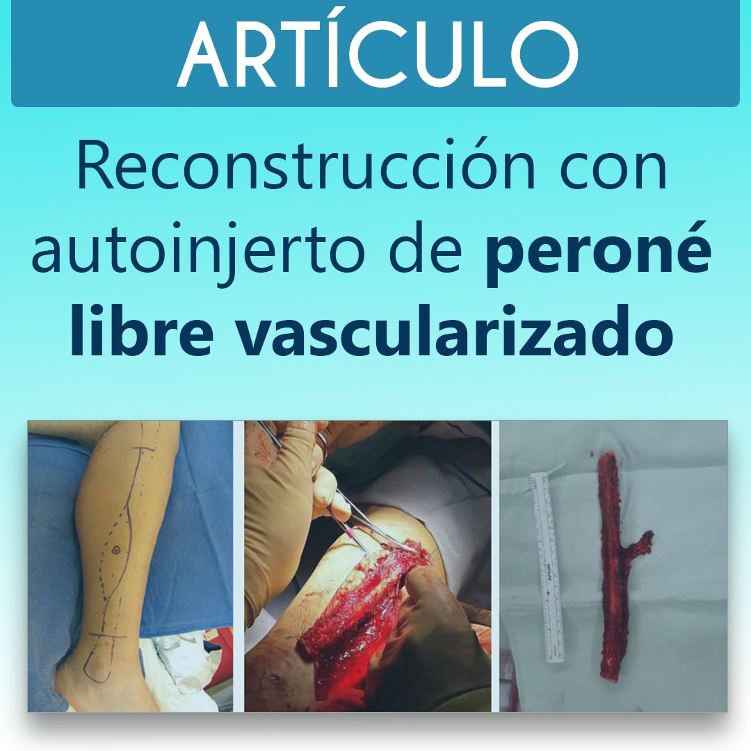 drgarcianovoa's tweet photo. 📝 Reconstrucción con Autoinjerto de PERONÉ LIBRE VASCULARIZADO.
Artículo completo en https://t.co/BJPAhmzPvC
.
Dr. Aldo Damian García Novoa
📲 6691430550
🌐 https://t.co/7msyvE7mvH
#traumatologia #fracturas #ortopedia #perone #reconstrucción #autoinjerto #vascularizado https://t.co/PvU21ABFE1