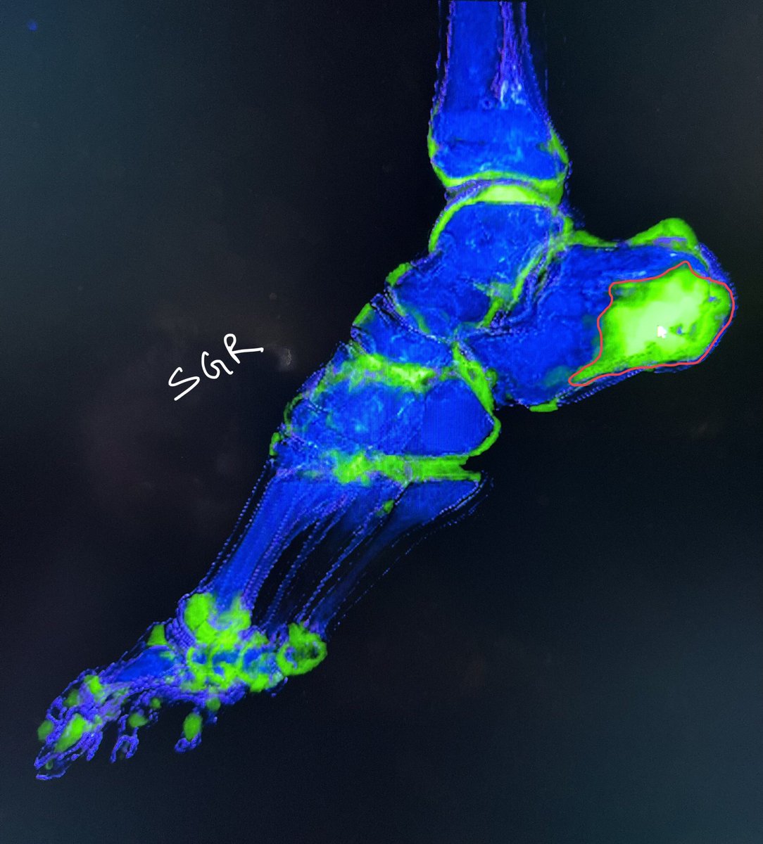 If one could earn money from #MedTwitter and knew #orthotwitter is this much engaging, I would have done #mskrad fellowship! 😬
This was calcaneus # #spectralCT History can be misleading!
xray is not always easy in real life: we often overcall or under all!
#radtwitter