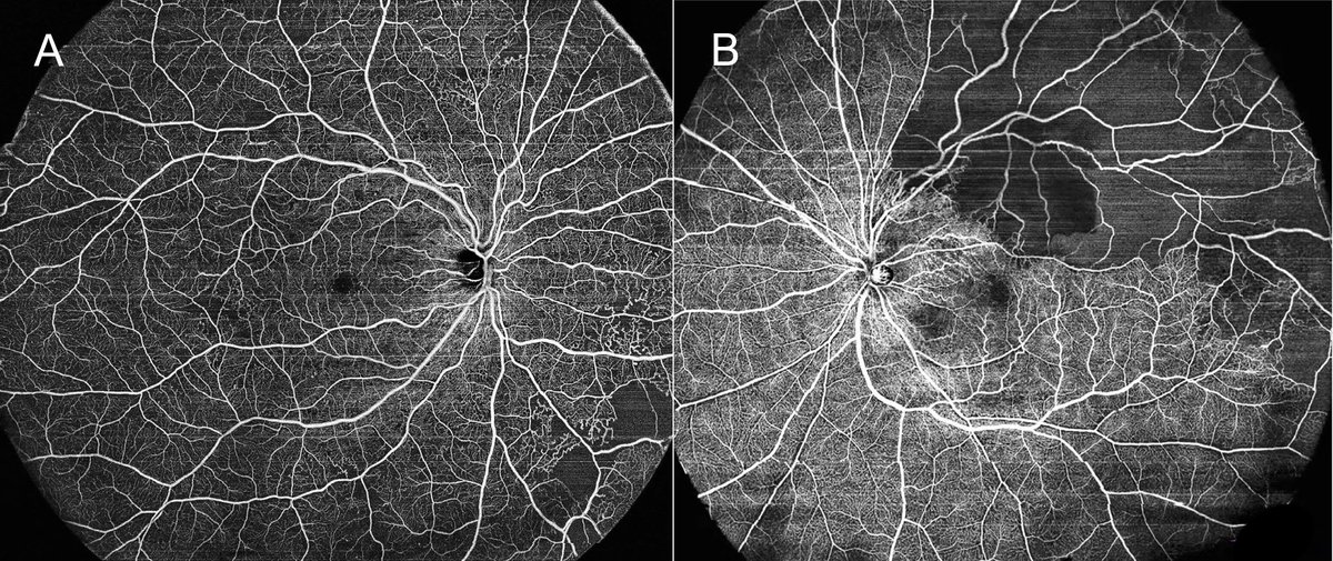 #aopr #ssoct
Advances in swept-source optical coherence tomography and optical coherence tomography angiography @ELS_Ophthal sciencedirect.com/science/articl…