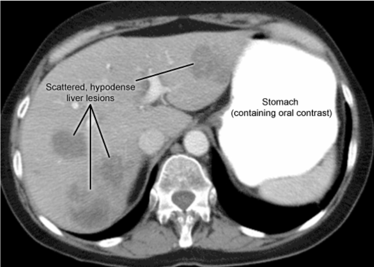 On Step exam: Seeing multiple lesions, scattered in characteristic, think of metastasis instead of liver origin adenoma or carcinoma. Suggest colonoscopy first of all as most of them originate from colon.

#medTwitter #MedEd #PathTwitter #radiology #IMtwitter #usmle