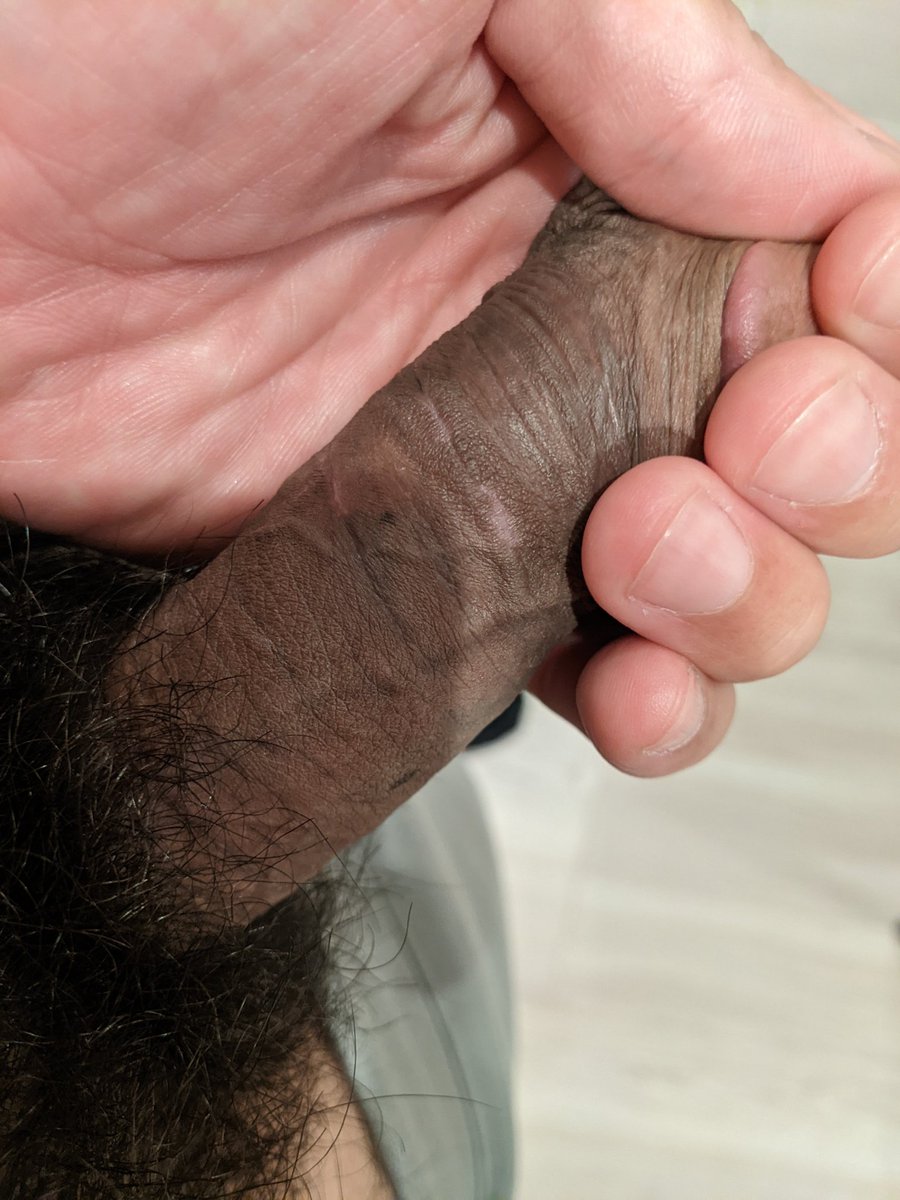 Temp329's tweet photo. サル痘治った！
最初はホクロみたいだったけどその後、カサブタになってパンツの中で張り付いたりして大変だったけど、やっとよく見れば痕があるぐらいにまでなった
とはいえ、いつまで身体の中にウイルスあるかわからんから遊べんなぁ。。。 https://t.co/IkBojcE4WD