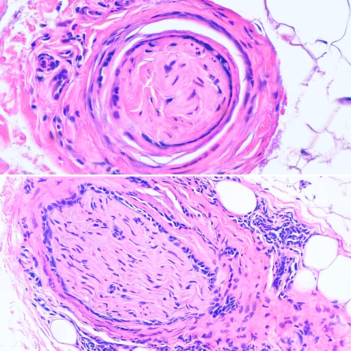 DiegoMoralesN's tweet photo. Perineural invasion of basal cell carcinoma (infiltrative pattern) can be EXYREMELY subtle & can be easily missed. Luckily I could suspect it and confirm with #ihcpath.
#JoyForMorfology #dermpath #FreudeAnDerMorphologie #pathfulness #pathology #patologia #PathTwitter https://t.co/7Czb28VpNY