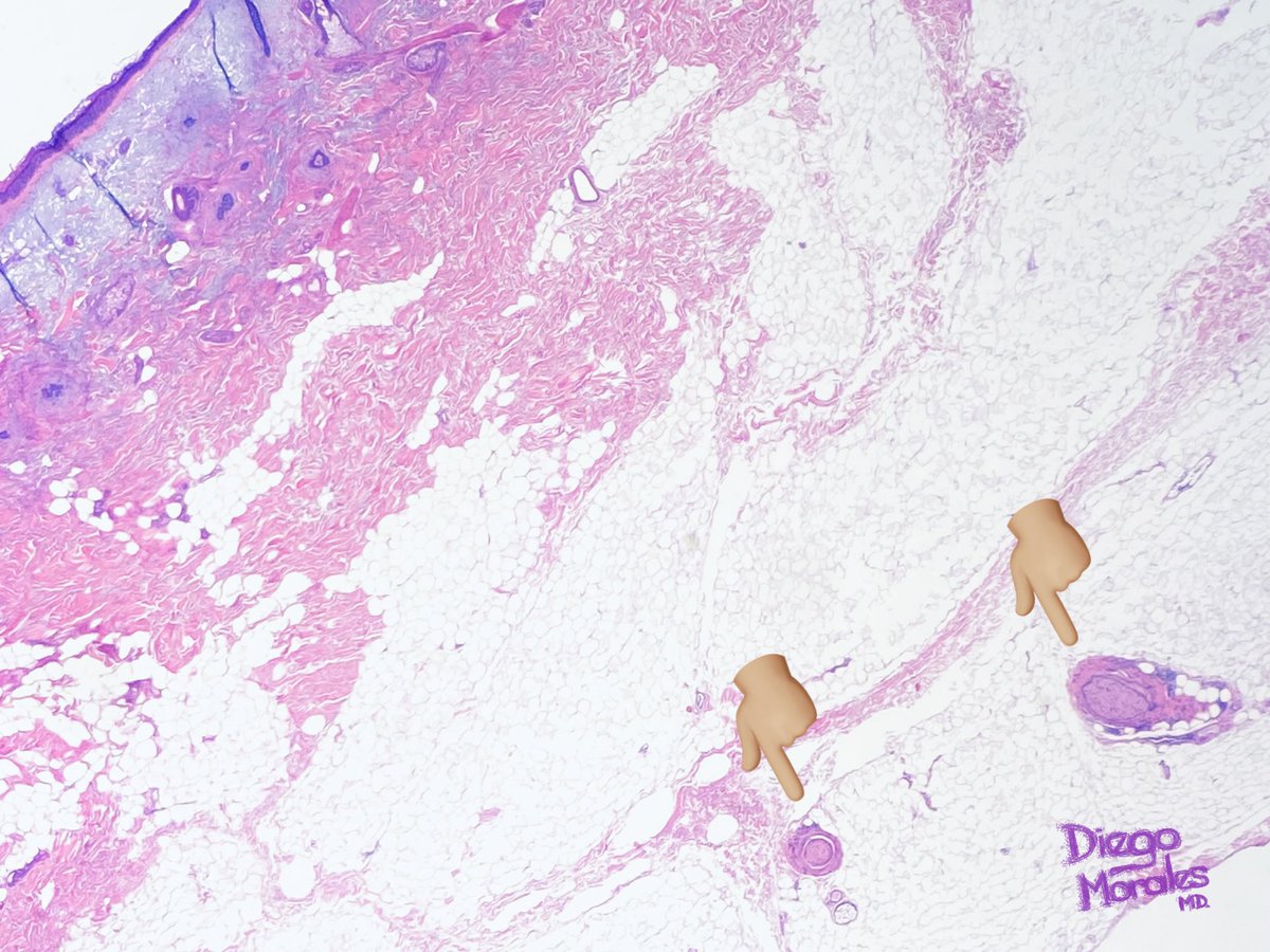 DiegoMoralesN's tweet photo. Perineural invasion of basal cell carcinoma (infiltrative pattern) can be EXYREMELY subtle & can be easily missed. Luckily I could suspect it and confirm with #ihcpath.
#JoyForMorfology #dermpath #FreudeAnDerMorphologie #pathfulness #pathology #patologia #PathTwitter https://t.co/7Czb28VpNY