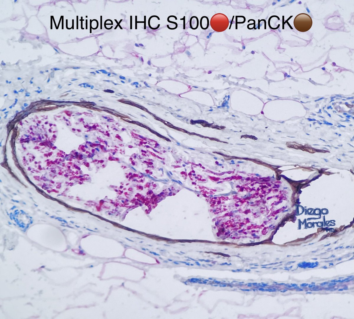 DiegoMoralesN's tweet photo. Perineural invasion of basal cell carcinoma (infiltrative pattern) can be EXYREMELY subtle & can be easily missed. Luckily I could suspect it and confirm with #ihcpath.
#JoyForMorfology #dermpath #FreudeAnDerMorphologie #pathfulness #pathology #patologia #PathTwitter https://t.co/7Czb28VpNY