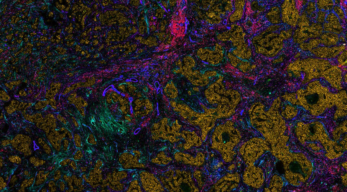 eriksahailab (@eriksahailab) on Twitter photo Opportunity to join our team & <a href="/TheCrick/">The Francis Crick Institute</a> to work on the tumour microenvironment funded by <a href="/ERC_Research/">European Research Council (ERC)</a> Applicants with diverse backgrounds encouraged. Please RT.
crick.wd3.myworkdayjobs.com/External/job/L… Opportunity to join our team & <a href="/TheCrick/">The Francis Crick Institute</a> to work on the tumour microenvironment funded by <a href="/ERC_Research/">European Research Council (ERC)</a> Applicants with diverse backgrounds encouraged. Please RT.
crick.wd3.myworkdayjobs.com/External/job/L…
