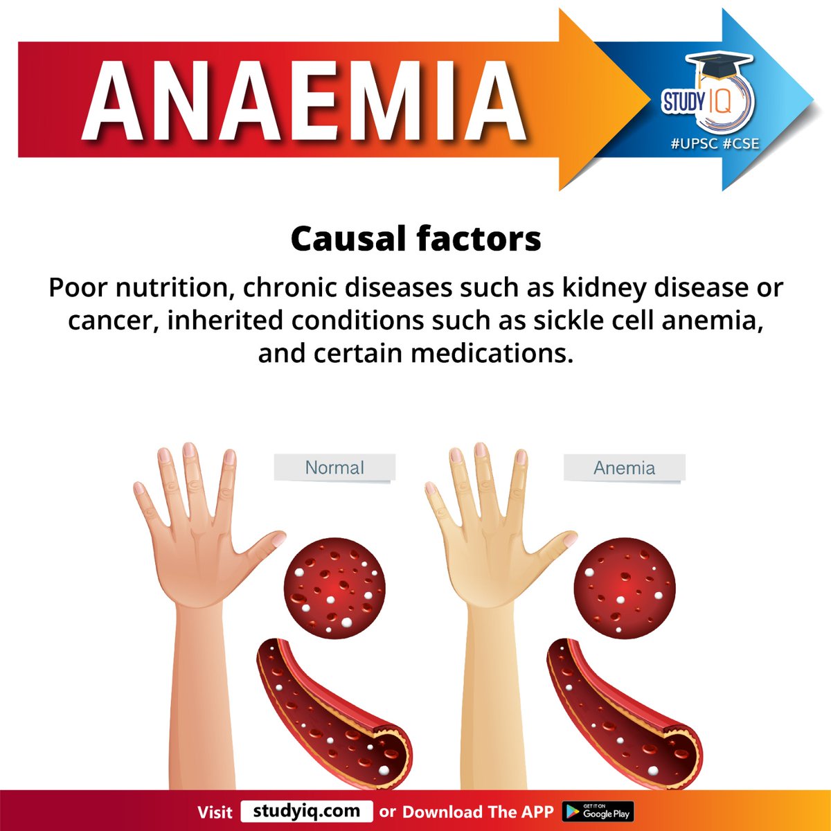 Anaemia

#anaemia #whyinnews #foodfortification #vitaminb12 #anaemiainwomen #redbloodcells #hemoglobin #blood #pregnantwomen #childmortality #lackofiron #bloodcells #hemolyticanemia #cancer #medications #medicalinterventions #upsc #cse #ips #ias