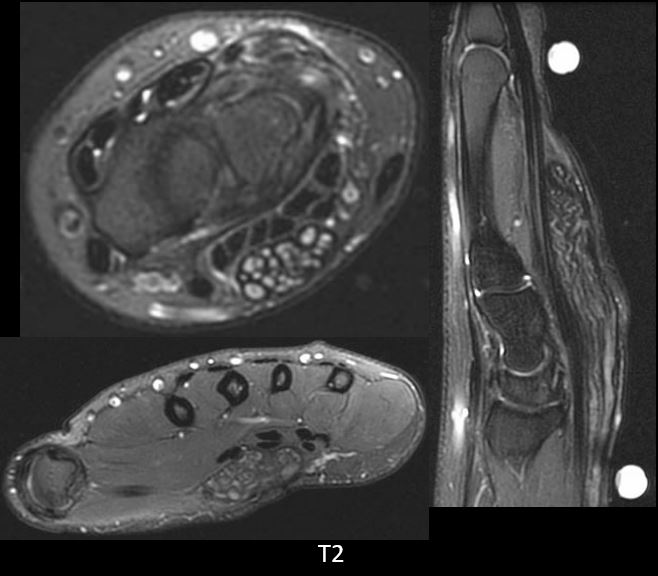 UW_MSKrad's tweet photo. #CaseOfTheWeek ‼️🎉‼️

☢️🩻☠️Case#18☠️🩻☢️

#Numbness &amp; #Tingling #HappyMay🌼🌷🌧️

➡️➡️📲Diagnosis❓❓

#MSKRad #FOAMrad #RadEd #OrthoTwitter #HandAndUpperExtremity @ssr_rwg @UWRadRes @HandSociety https://t.co/rkh9QP8rcg