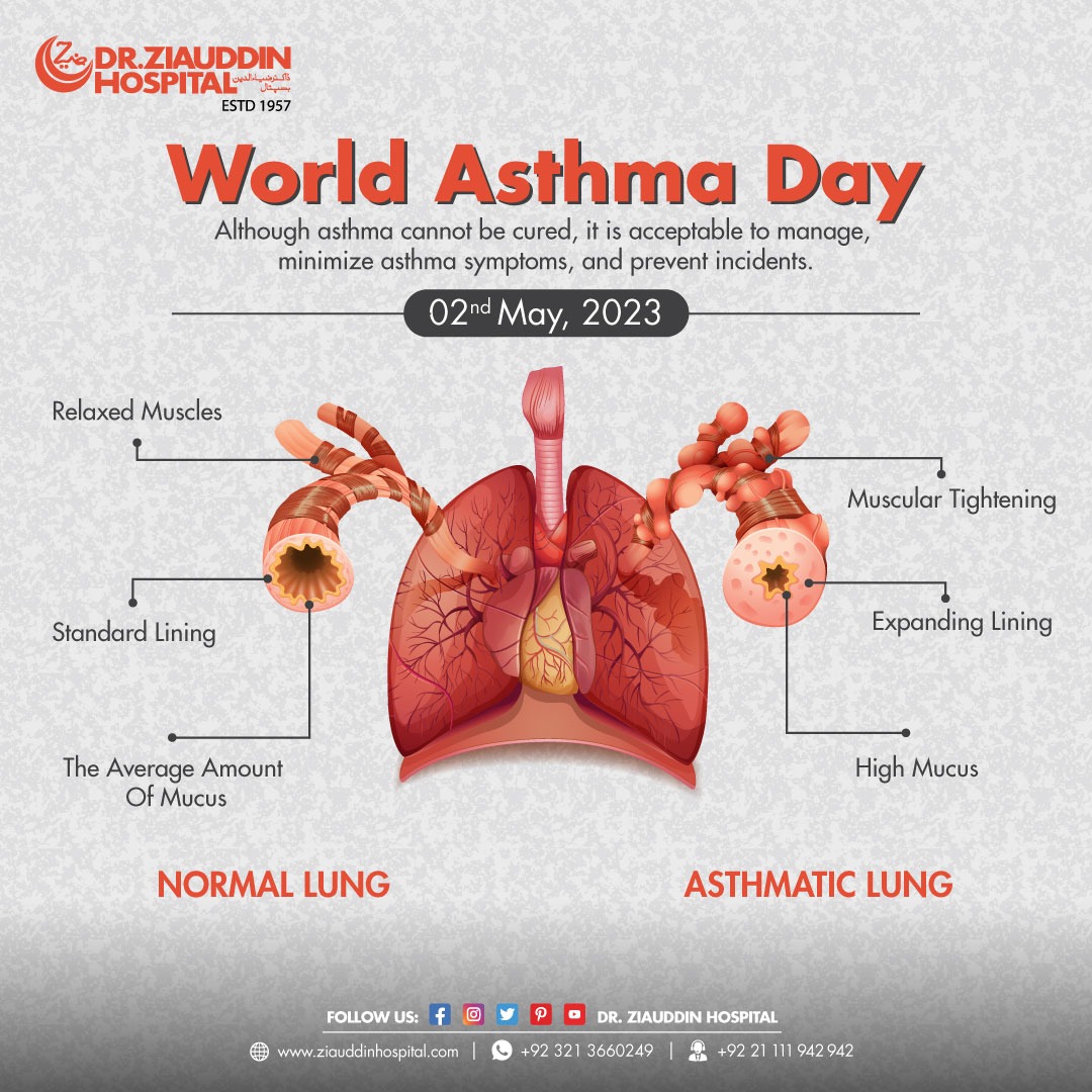 Dr. Ziauddin Hospital aims to educate and increase awareness of the condition on World Asthma Day in order to alleviate suffering and prevent mortality. 
#DZH #DrZiauddinHospital #asthma  #asthmacare #asthmaday #WorldAsthmaDay  #WorldAsthmaDay2023 #asthmaproblems #asthmatreatment
